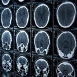 Brain Injuries And Legal Support