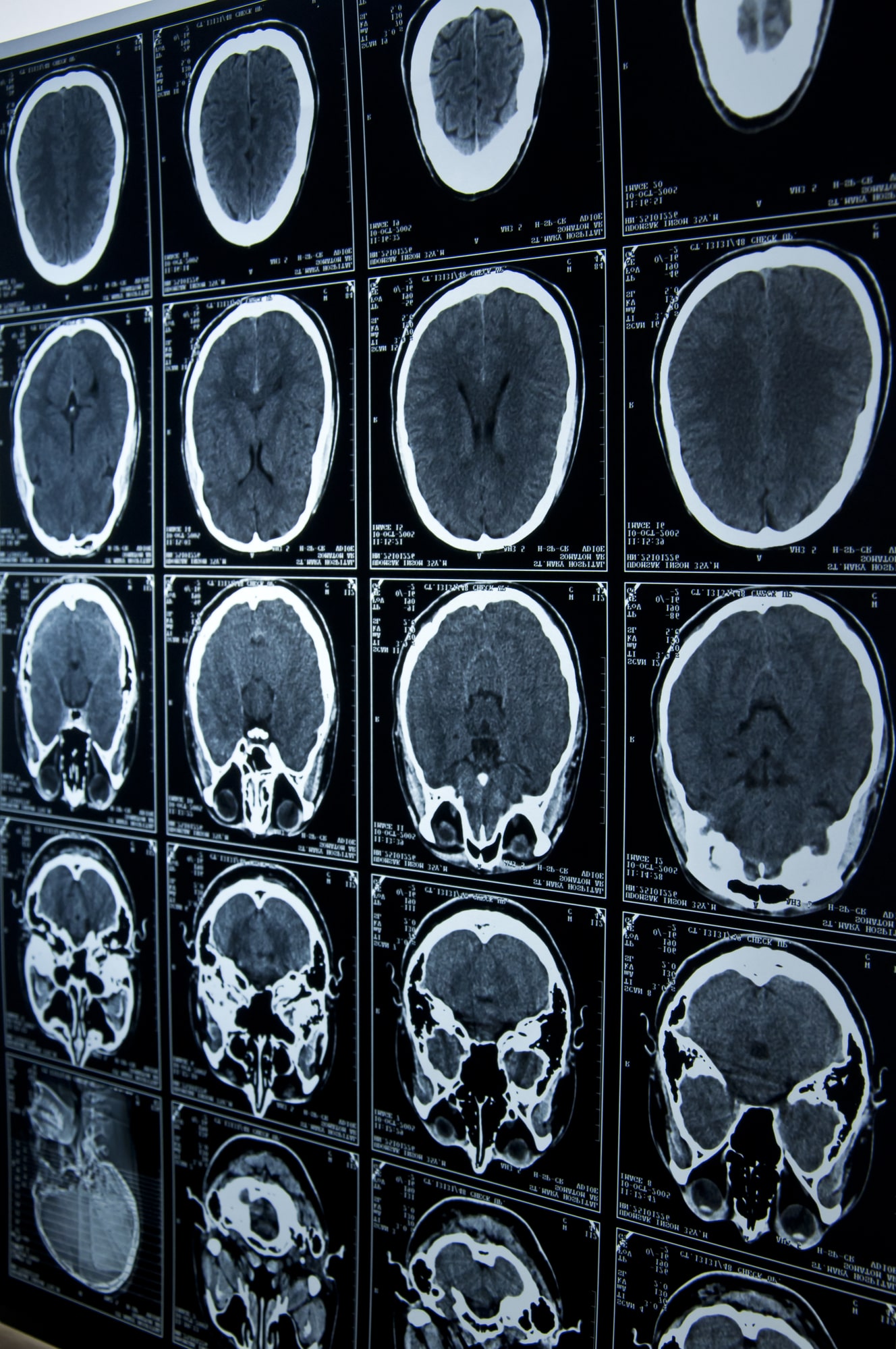 Read more about the article Brain Injuries And Legal Support